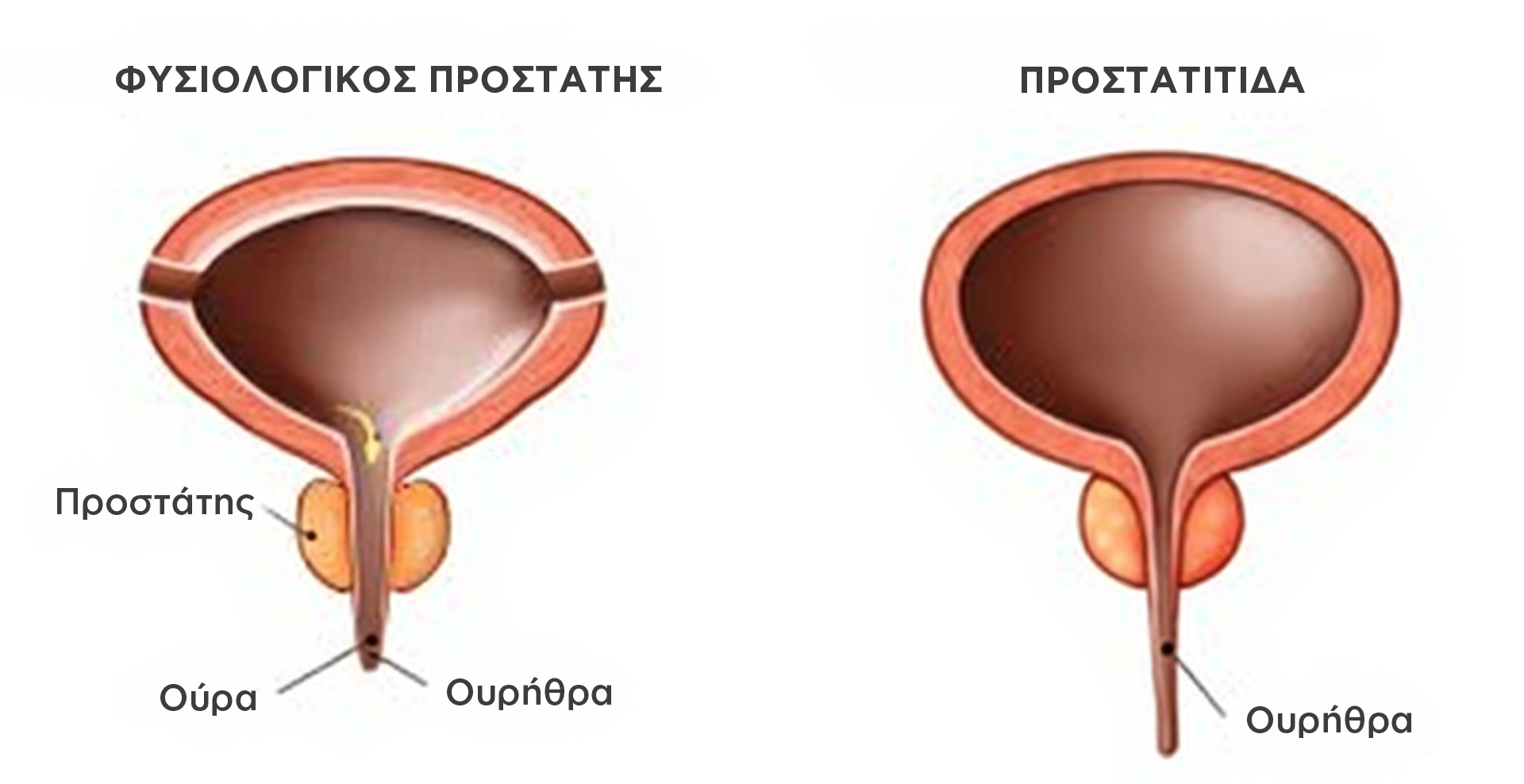 Χρόνια Προστατίτιδα