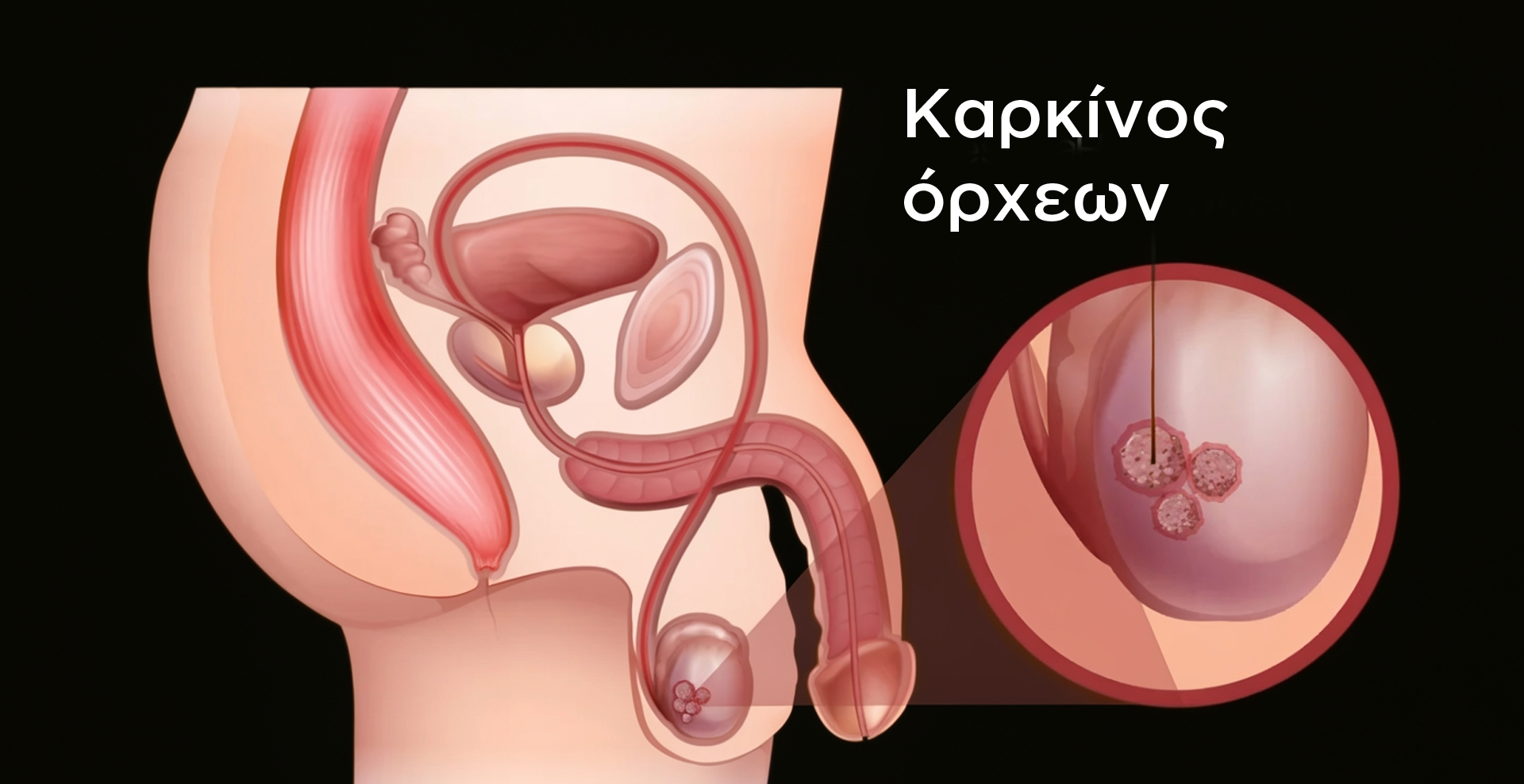 Καρκίνος Όρχεων