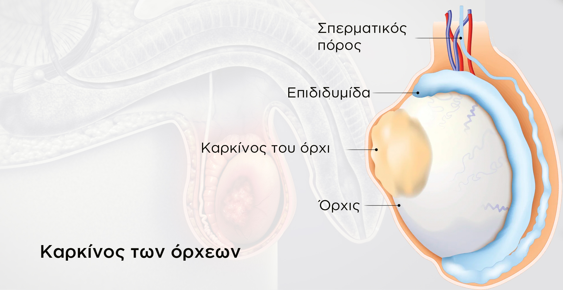 Καρκίνος του όρχι