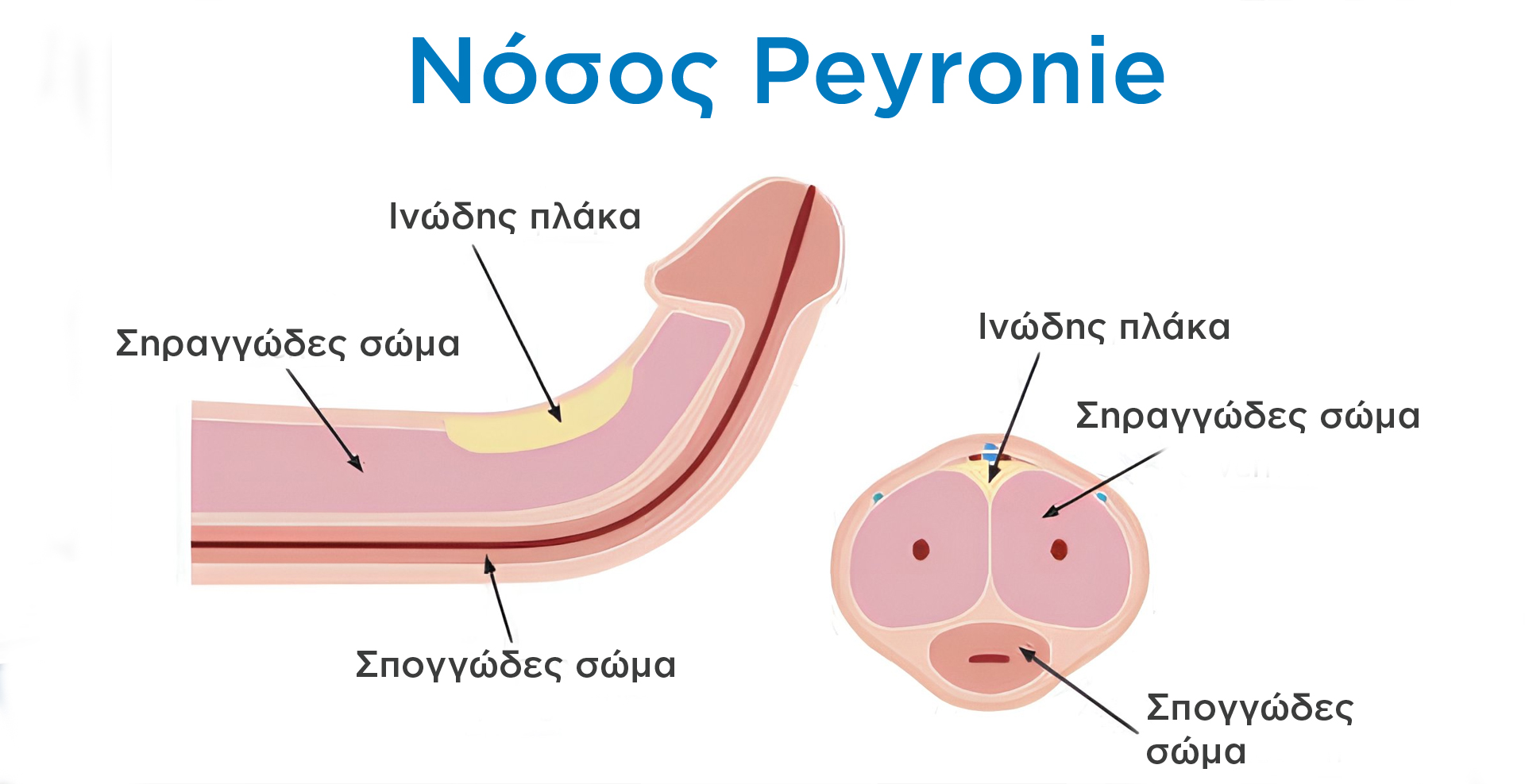 Νόσος Peyronie - Ανατομική αναπαράσταση