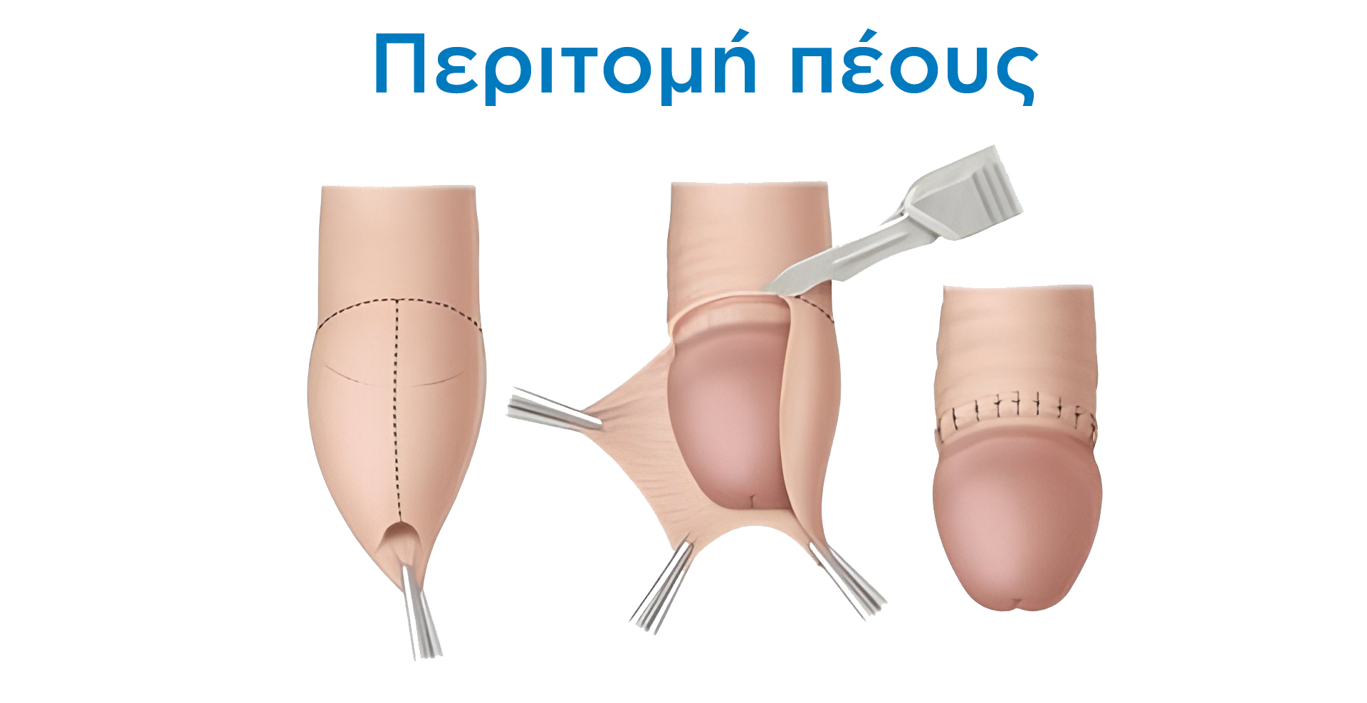 Περιτομή Πέους